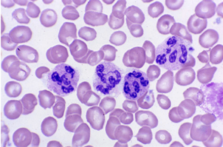 Hypersegmented Neutrophils