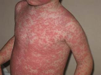 Amoxicillin-Rash-Pictures