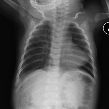tetralogy-of-fallot-1