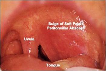 tonsils_-_peritonsillar_abscess1337554476726