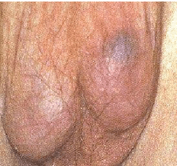 Fig-1-'Blue-dot'-sign-in-patients-with-a-left-torted-hydatid-or-Mor-gagni