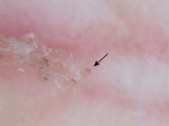  25 Scabies PAINE Podcast And Medical Blog