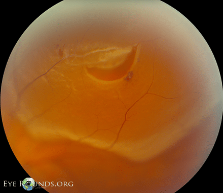 Rhegmatogenous Retinal Detachment