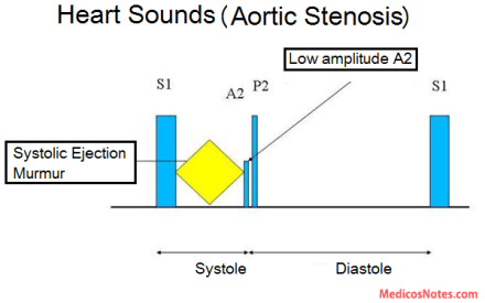 medicosnotes_heart-sounds-and-murmur-in-aortic-stenosis
