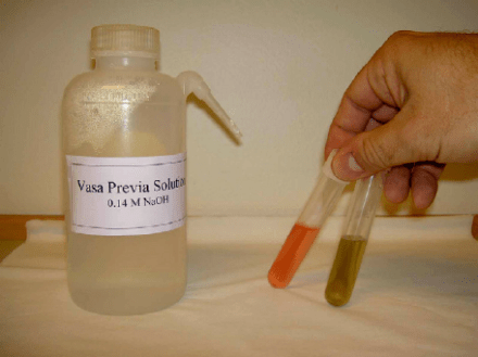 fig-2-the-complete-vasa-previa-testing-setup-shown-a-beaker-of-014-m-naoh-and-two