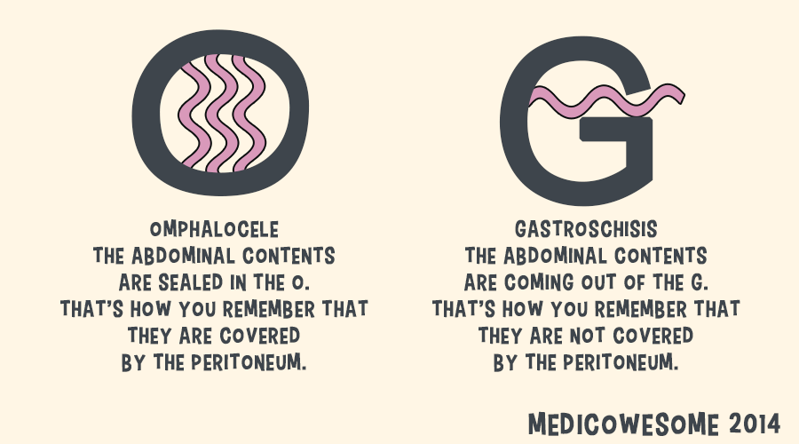 Image result for omphalocele vs gastroschisis